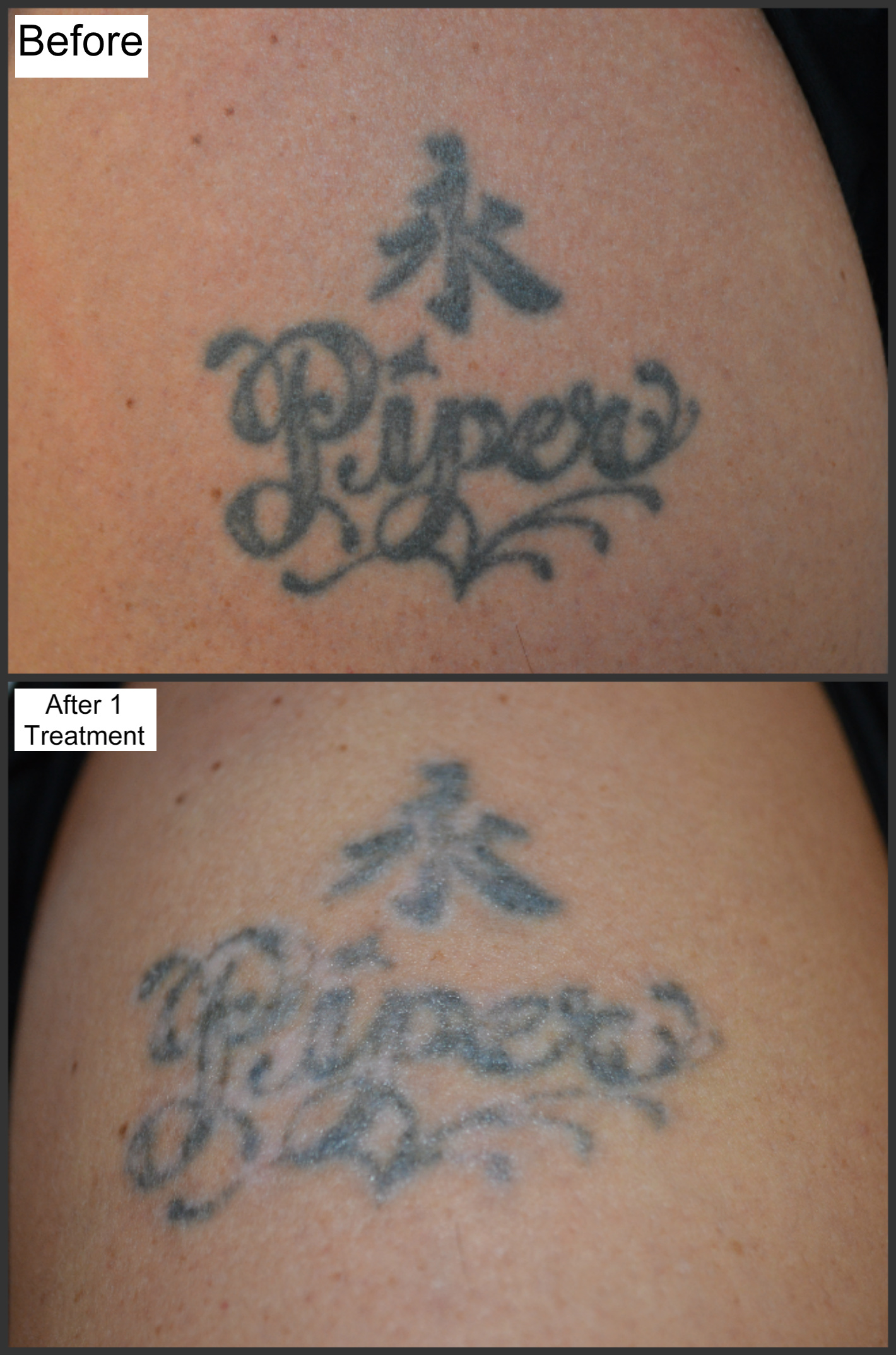 Best Ways to Avoid Tattoo Removal
