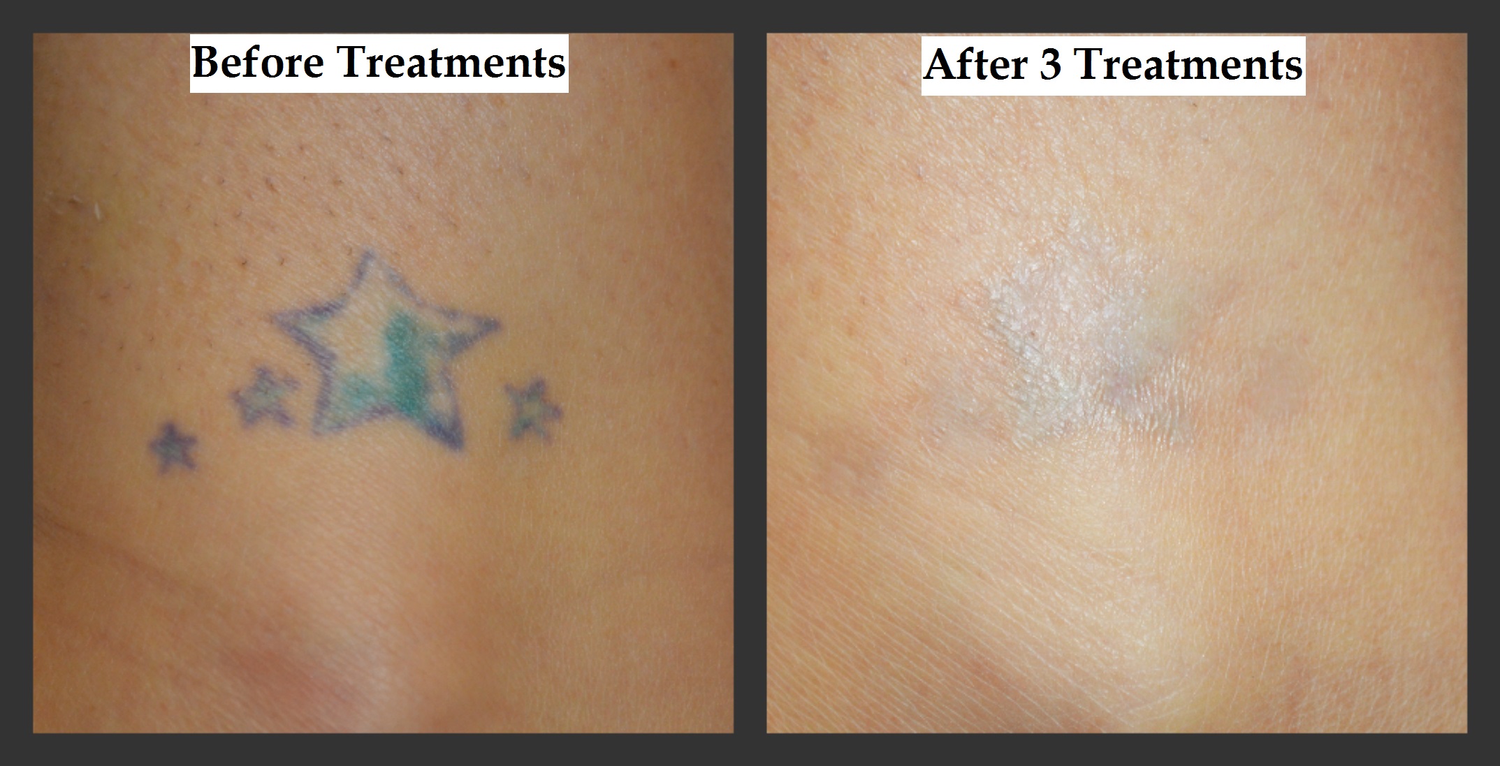 Tattoo Removal For Your Dream Job- Melbourne Fl
